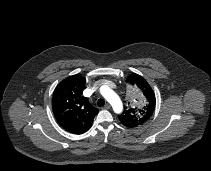 File:Acute pulmonary embolism with pulmonary infarcts (Radiopaedia 77688-89908 Axial C+ CTPA 12).jpg