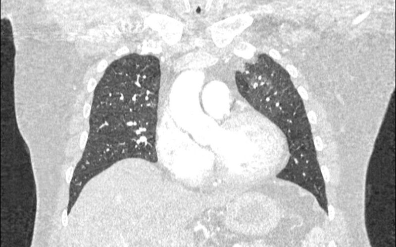 File:Acute pulmonary embolism with pulmonary infarcts (Radiopaedia 77688-89908 Coronal lung window 28).jpg