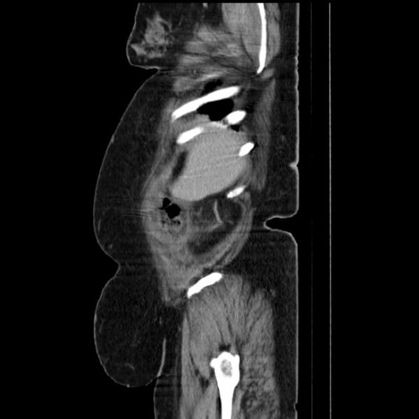 File:Acute pyelonephritis (Radiopaedia 25657-25837 Sagittal renal parenchymal phase 17).jpg