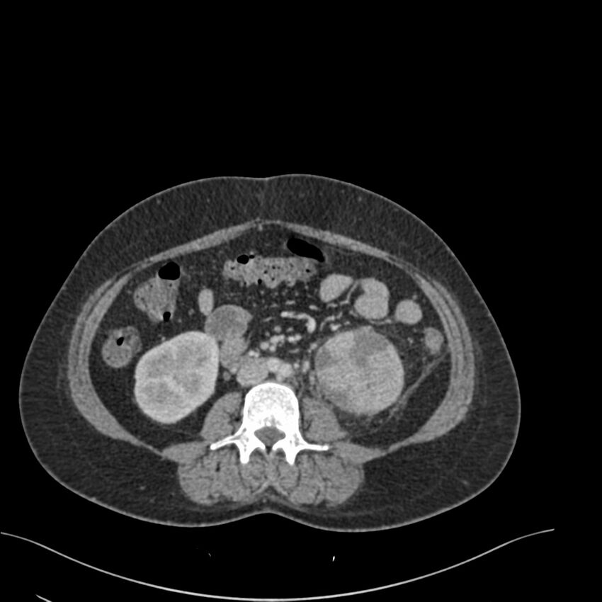 Acute pyelonephritis with renal vein thrombosis (Radiopaedia 58020-65053 Axial renal parenchymal phase 104).jpg