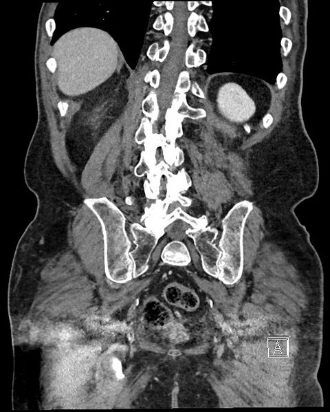 File:Acute renal infarction - rim capsular enhancement (Radiopaedia 59833-67270 Coronal C+ portal venous phase 51).jpg