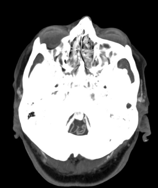 File:Acute right MCA M1 occlusion (Radiopaedia 62268-70454 Axial Phase 2 28).jpg