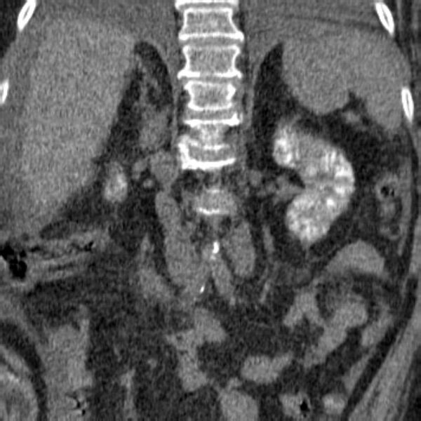 File:Acute tubular necrosis (Radiopaedia 28077-28334 Coronal non-contrast 8).jpg