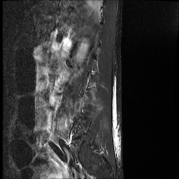 File:Acute vertebral body compression fractures (Radiopaedia 31757-32694 Sagittal STIR 16).jpg