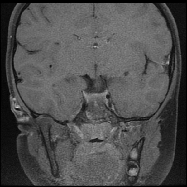 File:Adamantinomatous craniopharyngioma (Radiopaedia 77407-89529 Coronal T1 C+ fat sat 8).jpg