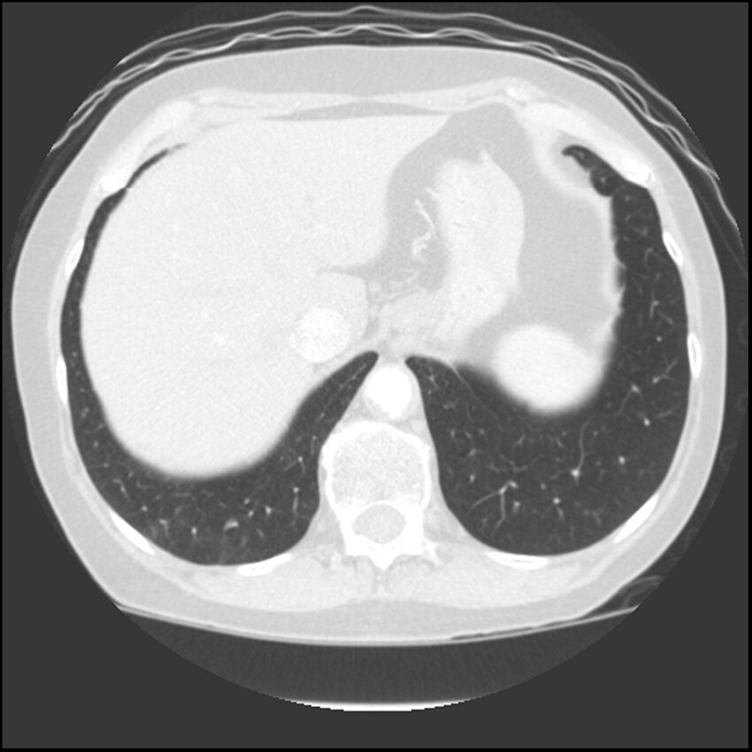 Adenocarcinoma of the lung (Radiopaedia 41015-43755 Axial lung window 108).jpg