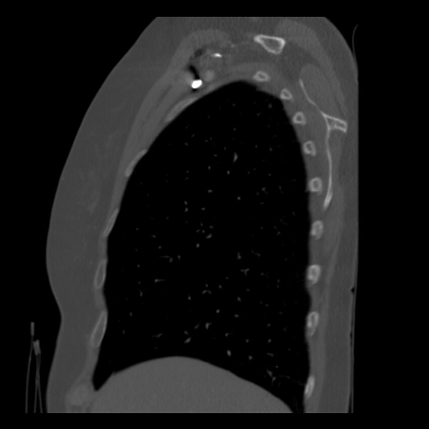 Adenocarcinoma of the lung (Radiopaedia 41015-43755 Sagittal bone window 15).jpg