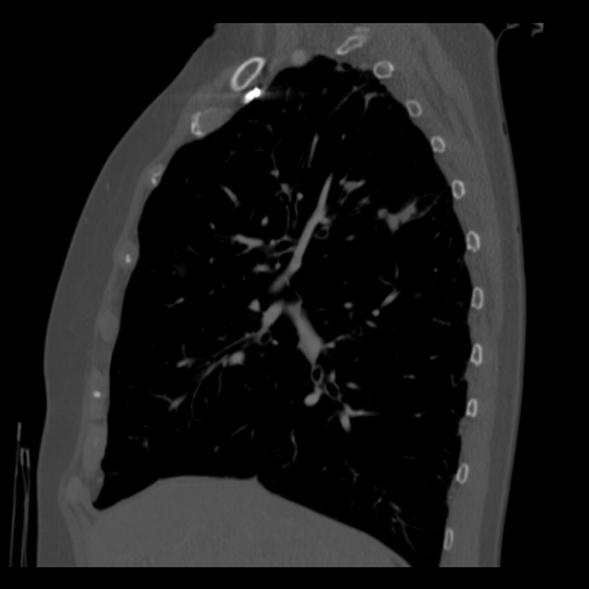 Adenocarcinoma of the lung (Radiopaedia 41015-43755 Sagittal bone window 34).jpg