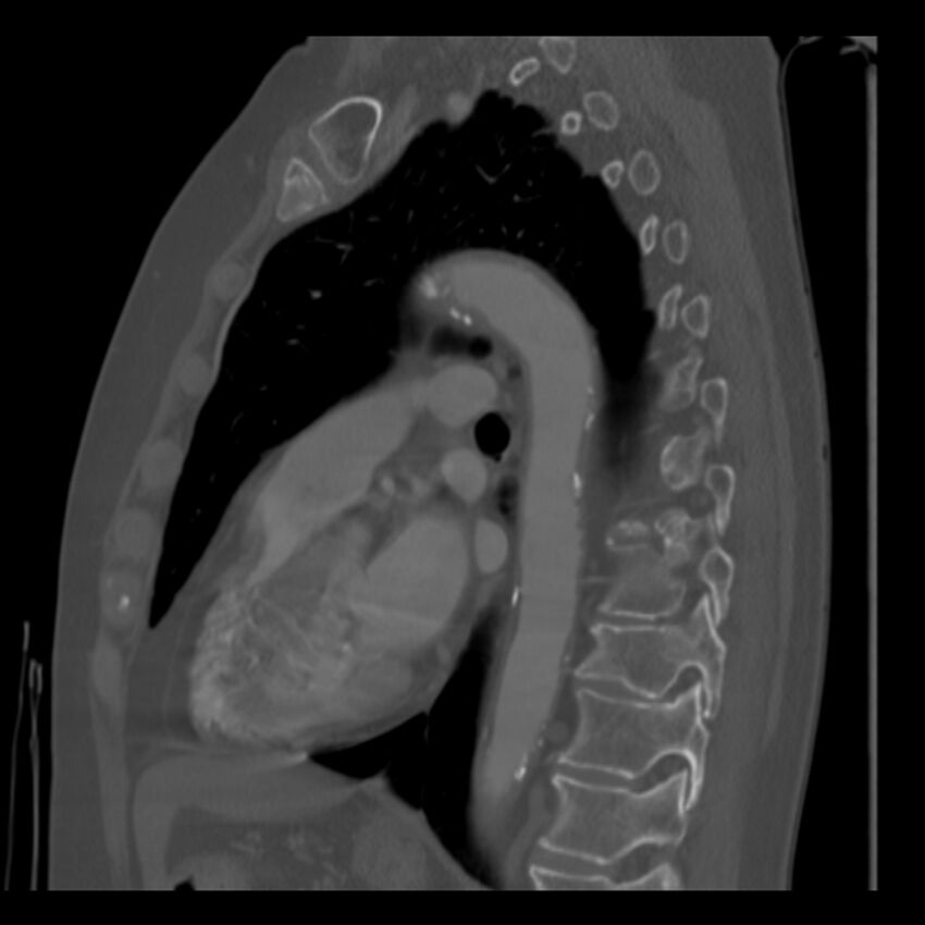 Adenocarcinoma of the lung (Radiopaedia 41015-43755 Sagittal bone window 62).jpg