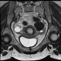 Adenoma malignum of the cervix (Radiopaedia 24460-24765 Coronal T2 11).jpg