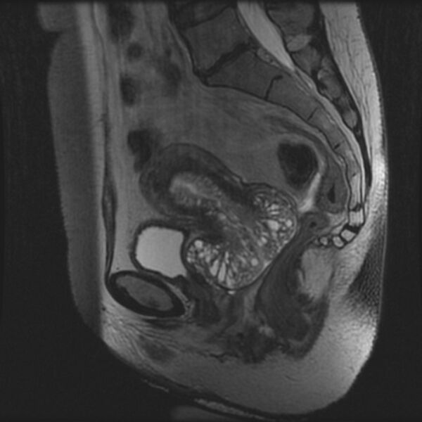 File:Adenoma malignum of the cervix (Radiopaedia 24460-24765 T2 58).jpg