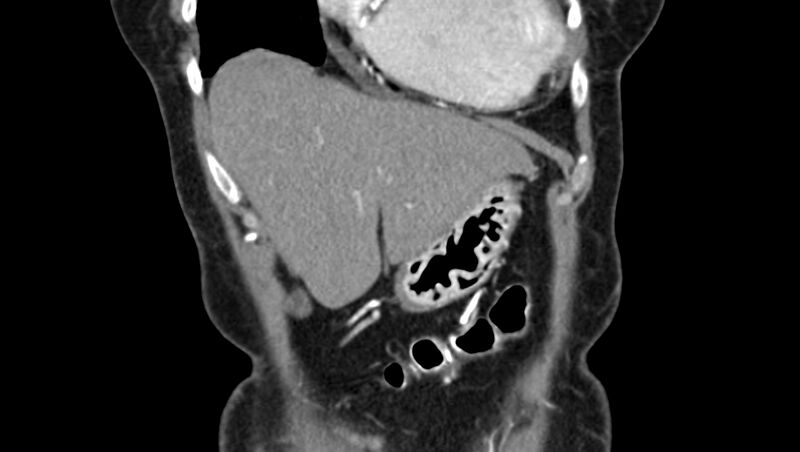 File:Adenomyomatosis of the gallbladder (Radiopaedia 12142-12483 Coronal C+ arterial phase 2).jpg