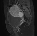 Adenomyosis - ovarian endometriomas (Radiopaedia 67031-76350 Sagittal T1 C+ fat sat 8).jpg