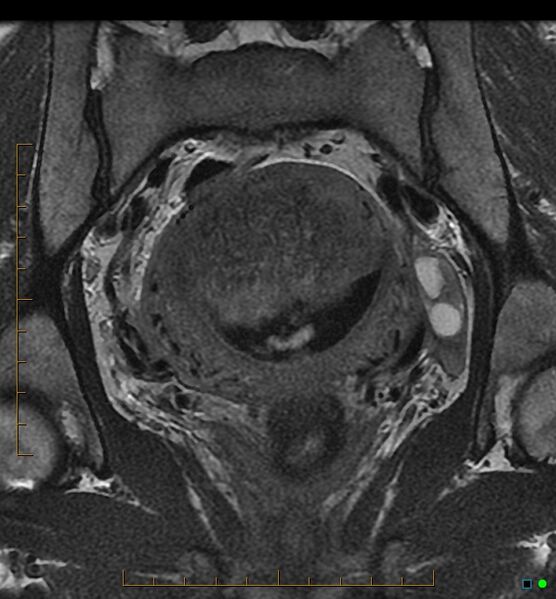 File:Adenomyosis uterus with hematometra (Radiopaedia 45779-50011 Coronal T2 12).jpg