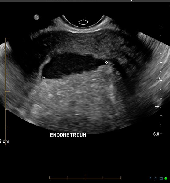 File:Adenomyosis uterus with hematometra (Radiopaedia 45779-51705 C 1).jpg