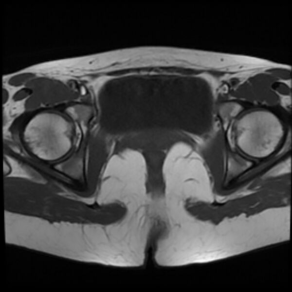 File:Adenomyosis within a septate uterus (Radiopaedia 69963-79981 Axial T1 22).jpg