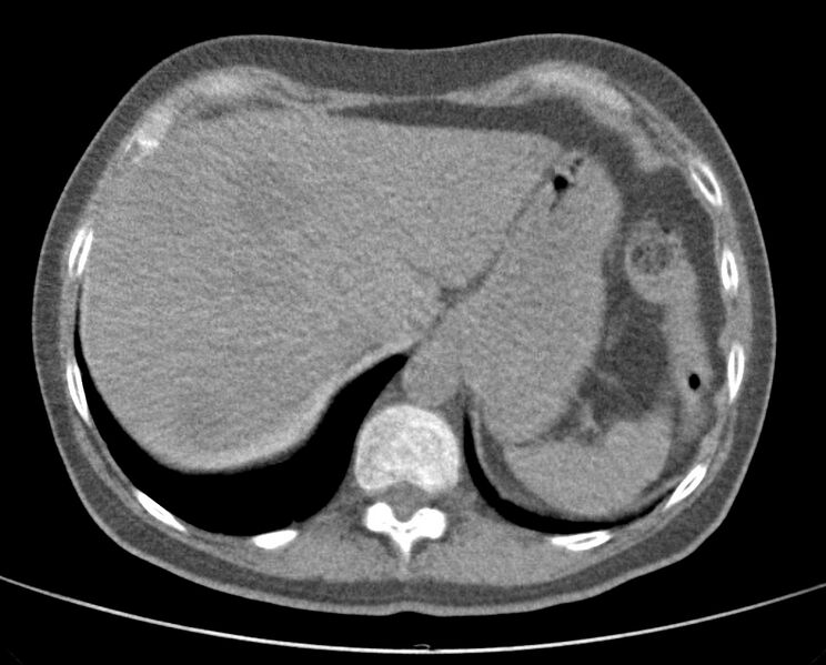 File:Adenosquamous lung carcinoma (Radiopaedia 22035-22030 non-contrast 54).jpg