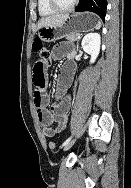 File:Adhesional small bowel obstruction (Radiopaedia 58900-66131 Sagittal C+ portal venous phase 161).jpg