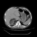 Adrenal myelolipoma (Radiopaedia 41843-44834 Axial non-contrast 11).jpg