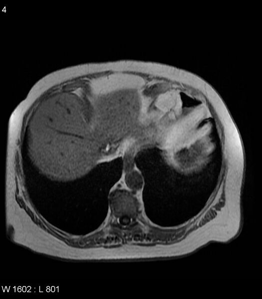 File:Adrenal myelolipoma (Radiopaedia 6765-7961 Axial T1 in-phase 4).jpg