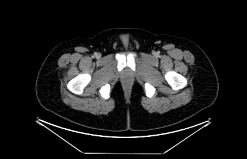 File:Adrenocortical carcinoma (Radiopaedia 80134-93438 Axial C+ portal venous phase 137).jpg