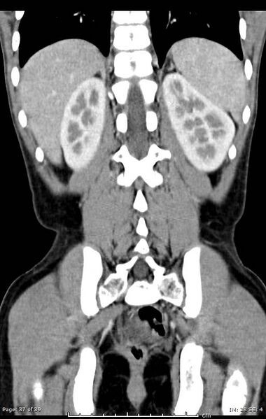 File:Agenesis of the gallbladder (Radiopaedia 55454-61905 A 37).jpg