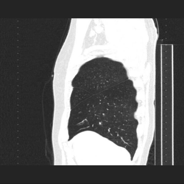File:Allergic bronchopulmonary aspergillosis (Radiopaedia 21386-21320 Sagittal lung window 17).jpg
