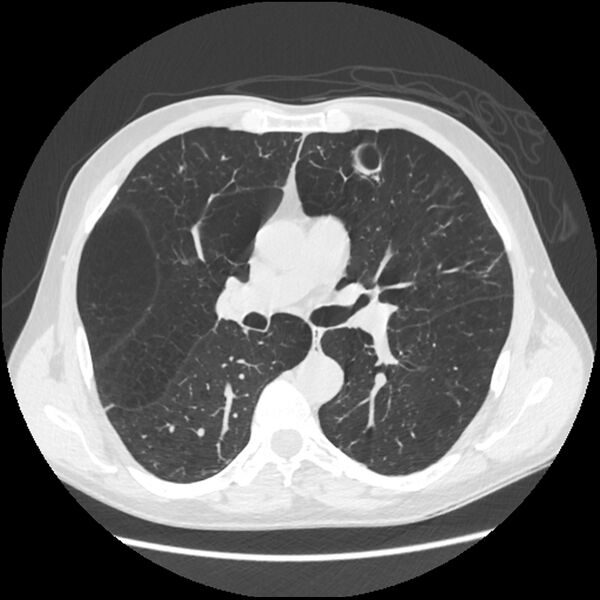File:Alpha-1-antitrypsin deficiency (Radiopaedia 40993-43722 Axial lung window 108).jpg