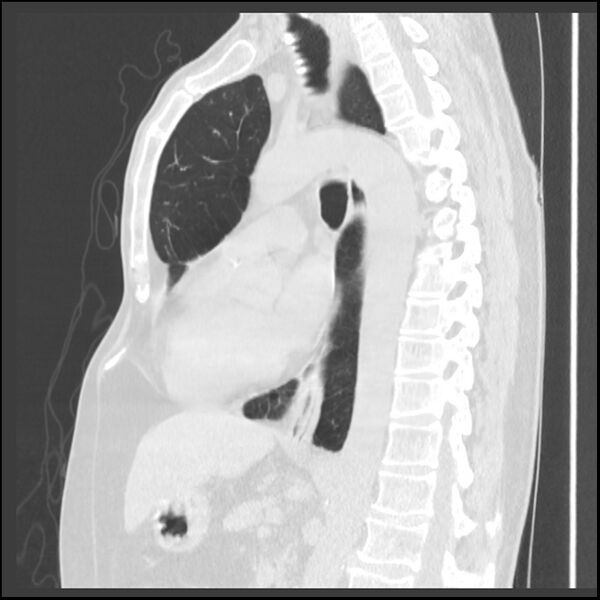 File:Alpha-1-antitrypsin deficiency (Radiopaedia 40993-43722 Sagittal lung window 127).jpg