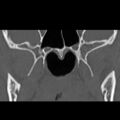Ameloblastic fibro-odontoma (Radiopaedia 18843-18780 B 23).jpg