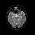 Amnestic syndrome secondary to hypoxic brain injury (Radiopaedia 24743-25004 DWI 44).jpg