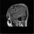 Amnestic syndrome secondary to hypoxic brain injury (Radiopaedia 24743-25004 T1 2).jpg