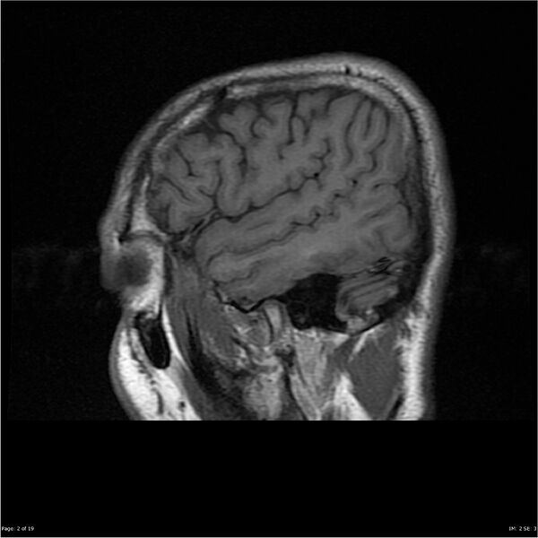 File:Amnestic syndrome secondary to hypoxic brain injury (Radiopaedia 24743-25004 T1 2).jpg