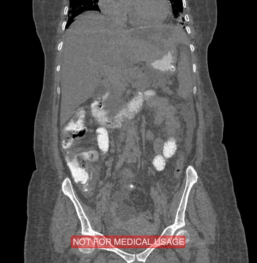 Amoebic enterocolitis with liver abscess (Radiopaedia 35100-36609 B 88).jpg