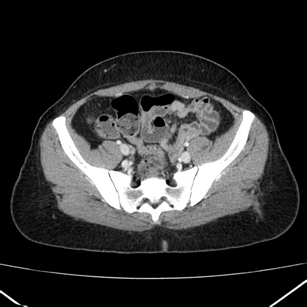File:Ampullary tumor (Radiopaedia 22787-22816 C 54).jpg