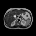 Ampullary tumor (Radiopaedia 27294-27479 T2 18).jpg