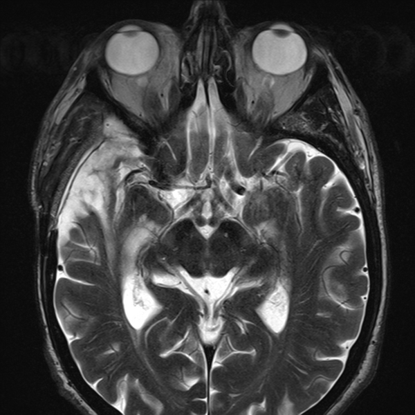 File:Anaplastic meningioma with recurrence (Radiopaedia 34452-35788 Axial T2 9).png