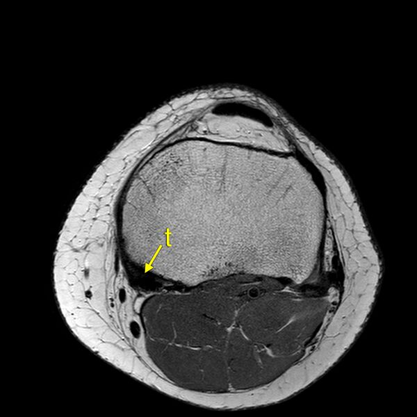 File:Anatomy Quiz (MRI knee) (Radiopaedia 43478-46866 A 21).jpeg