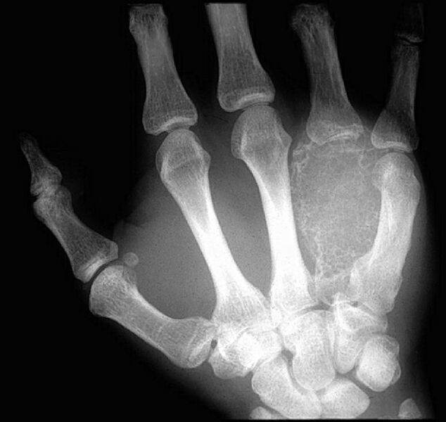 File:Aneurysmal bone cyst (Radiopaedia 11184).jpg