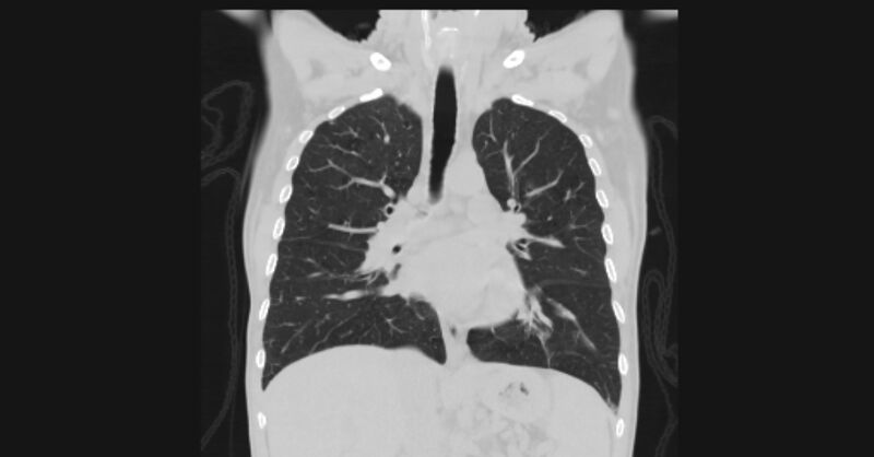 File:Angioinvasive aspergellosis (Radiopaedia 66995-76315 Coronal lung window 32).jpg