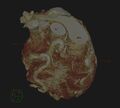 Anomalous left coronary artery from the pulmonary artery (ALCAPA) (Radiopaedia 40884-43586 3D reconstruction 3).jpg