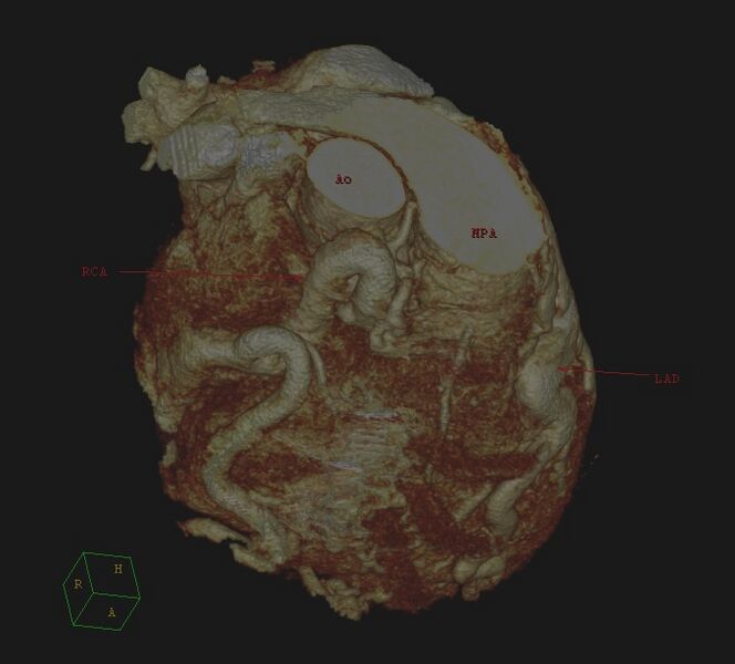 File:Anomalous left coronary artery from the pulmonary artery (ALCAPA) (Radiopaedia 40884-43586 3D reconstruction 3).jpg