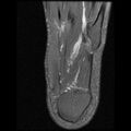Anterior calcaneal process fracture (Radiopaedia 74654-85611 Axial PD fat sat 26).jpg