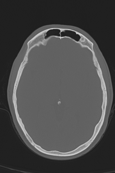 File:Anterior nasal spine fracture (Radiopaedia 46138-50494 Axial bone window 31).png