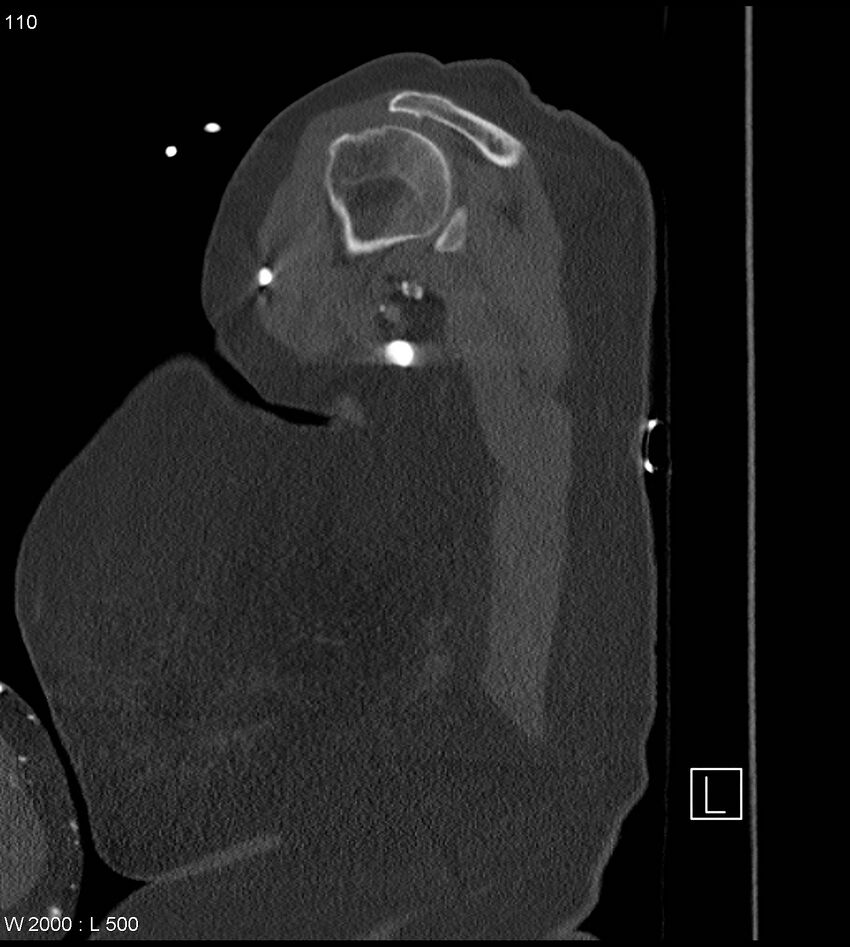 Anterior shoulder dislocation (CT) (Radiopaedia 59032-66309 Sagittal bone window 55).jpg