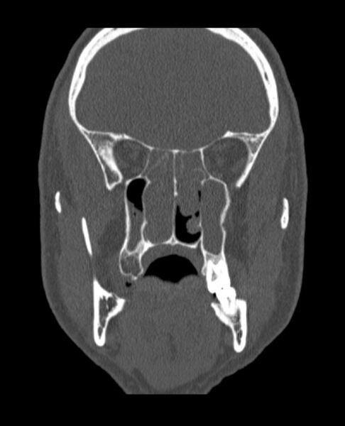 File:Antrochoanal polyp (Radiopaedia 79011-92169 Coronal bone window 38).jpg