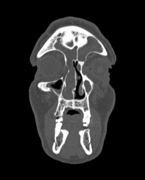 File:Antrochoanal polyp (Radiopaedia 79011-92169 Coronal bone window 71).jpg