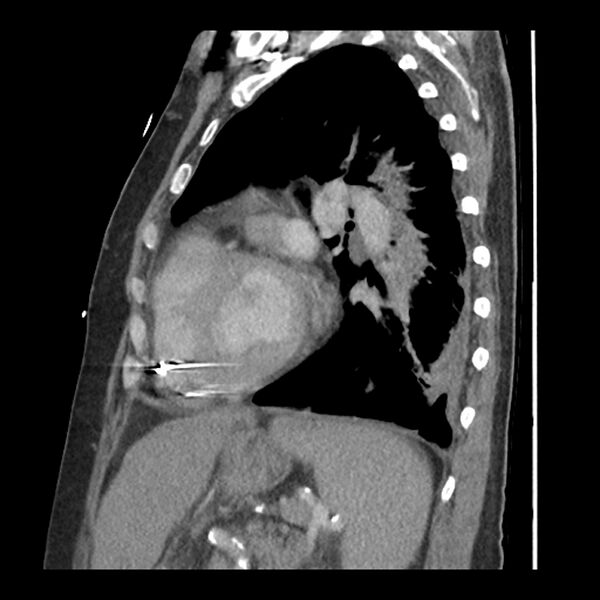 File:Aortic arch graft infection (FDG PET-CT) (Radiopaedia 71975-82437 C 47).jpg