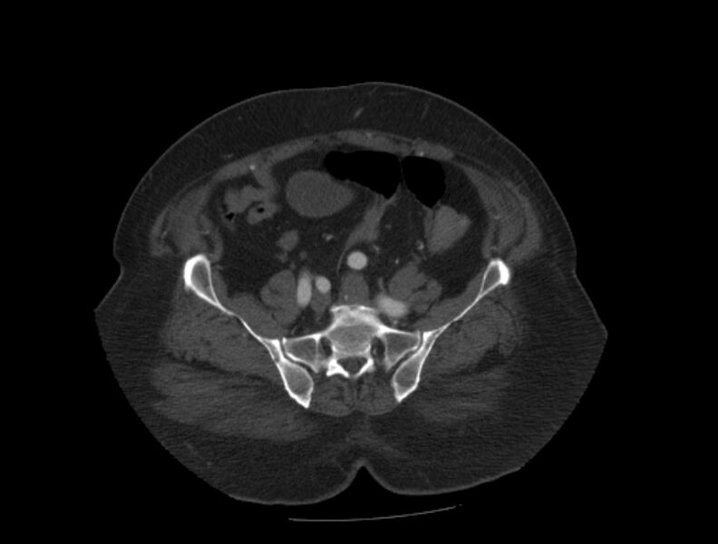 File:Aortic dissection (Radiopaedia 28802-29105 A 84).jpg
