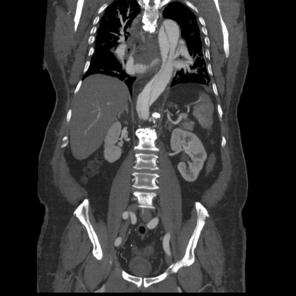 File:Aortic dissection (Radiopaedia 28802-29105 B 23).jpg